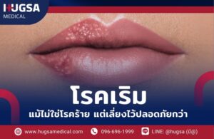 โรคเริม แม้ไม่ใช่โรคร้าย แต่เลี่ยงไว้ปลอดภัยกว่า